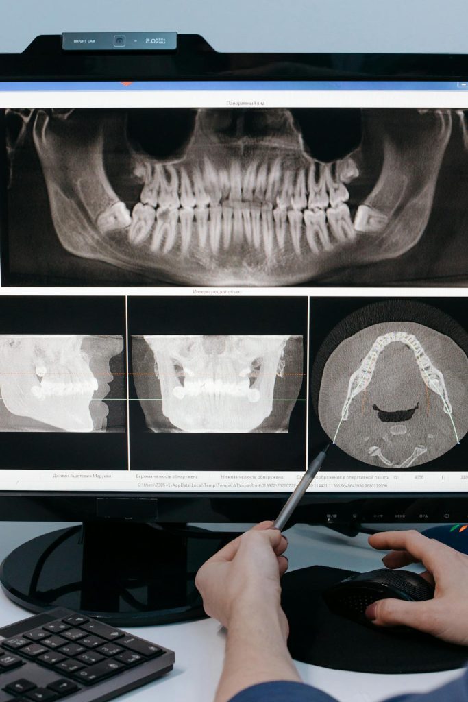 Illustration: untreated cavity consequences — Saratoga Smiles dental health blog